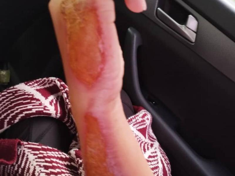 In Bishkek, a man tortured his common-law wife by burning her with an iron