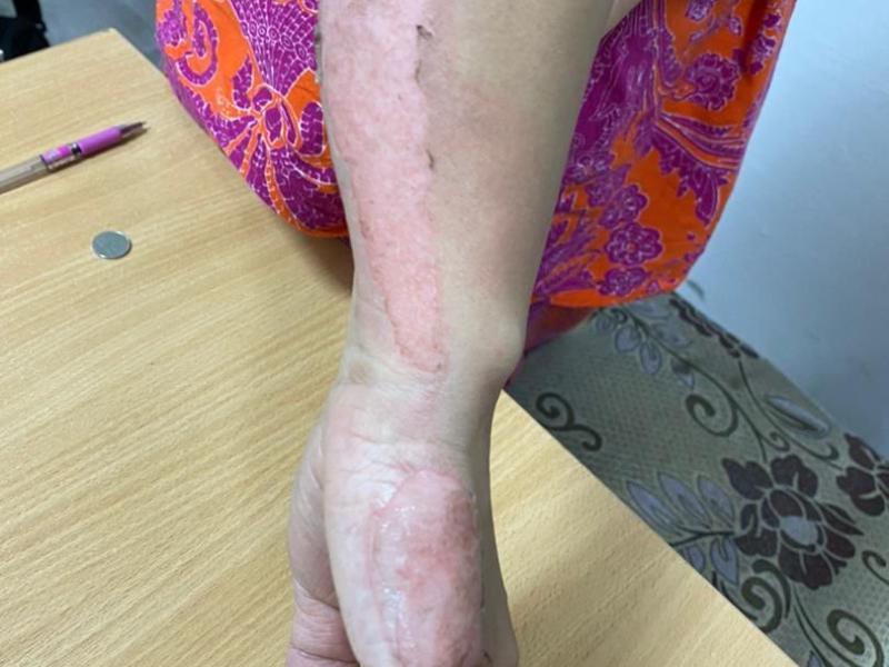 In Bishkek, a man tortured his common-law wife by burning her with an iron